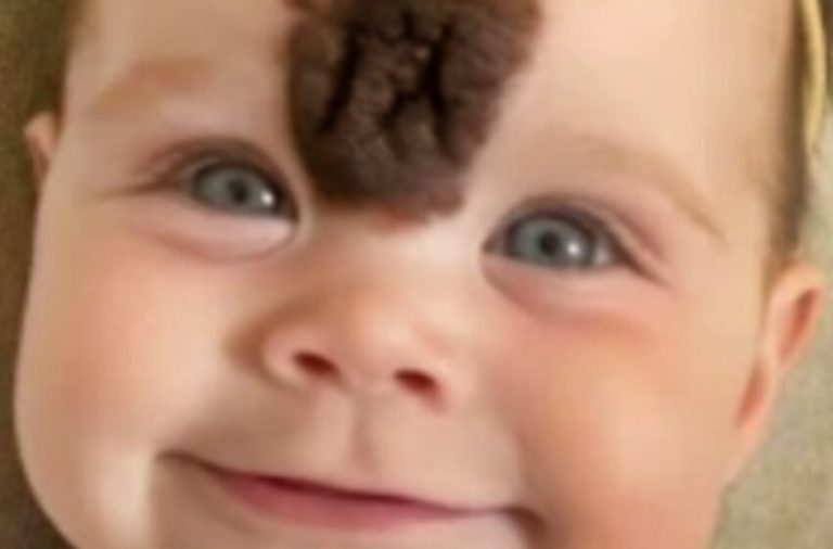 «People Will No Longer Point Fingers at Her»: Parents Decide to Remove Facial Birthmark to Protect Daughter from Cruelty