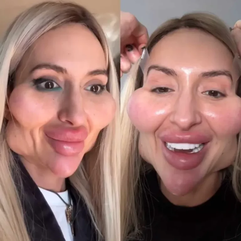 Ukrainian Woman with the World’s Largest Cheekbones Turns Heads in Public