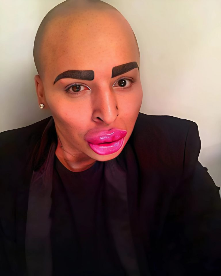 “I Want to Be Like Her”: Man Spends $150,000 on Plastic Surgery to Look Like Kim Kardashian