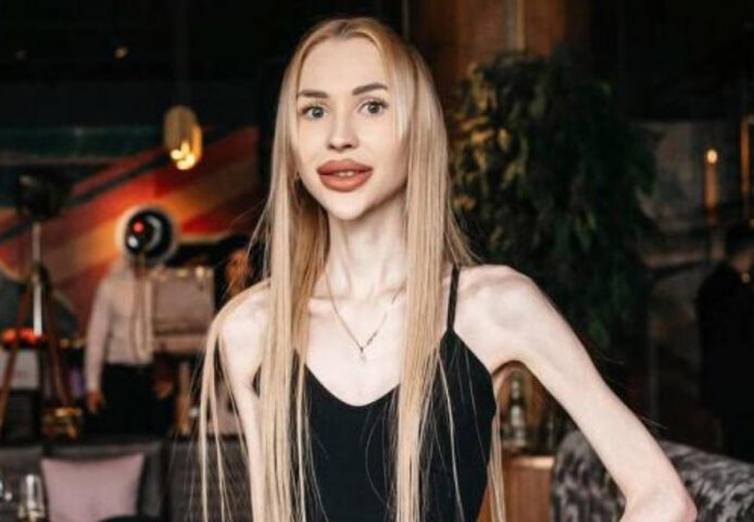 Хочется плакать. 23-килограммовая украинка показала, как она выглядела до похудения