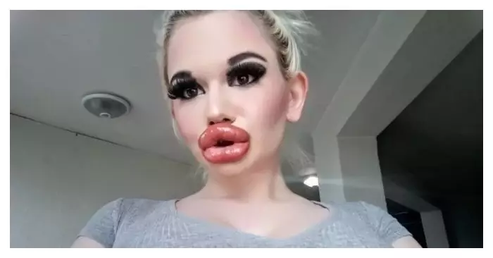 «The world’s biggest lips!» This is what the girl with multiple plastic surgeries looked like before