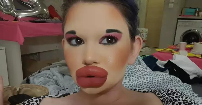 «Before duck lips!» Here is what the girl with the biggest lips looked like before plastic surgery